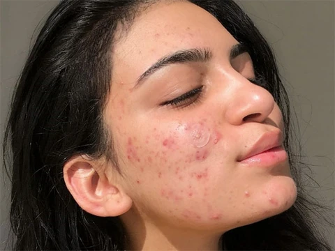 giải pháp chăm sóc da mụn