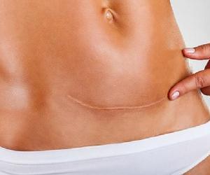 Cách giảm mỡ bụng sau sinh tại nhà hiệu quả và đơn giản nhất