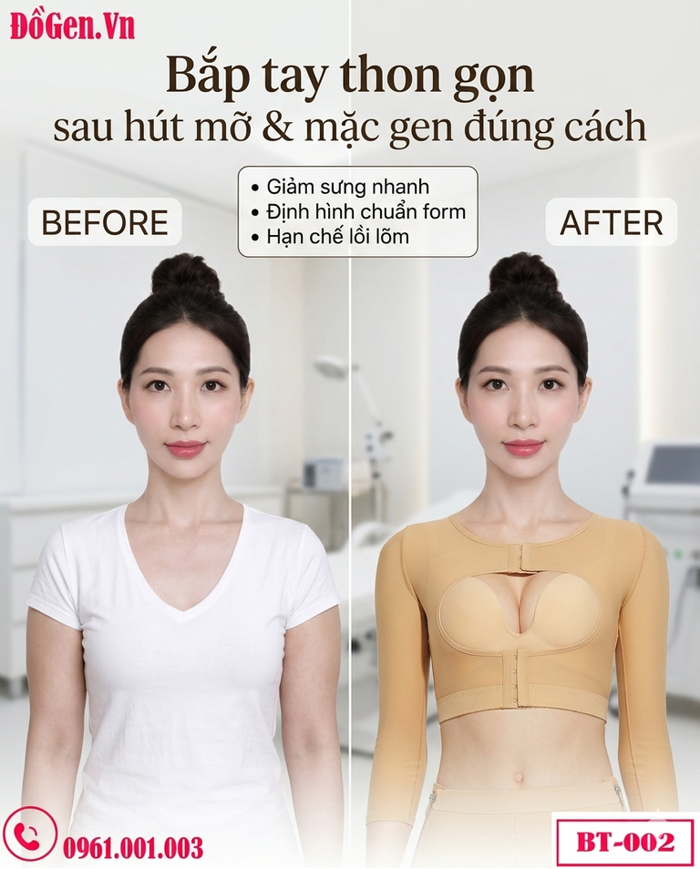 Hút Mỡ Bắp Tay Bị Lồi Lõm: Nguyên Nhân & Cách Chọn Áo Gen Định Hình Chuẩn