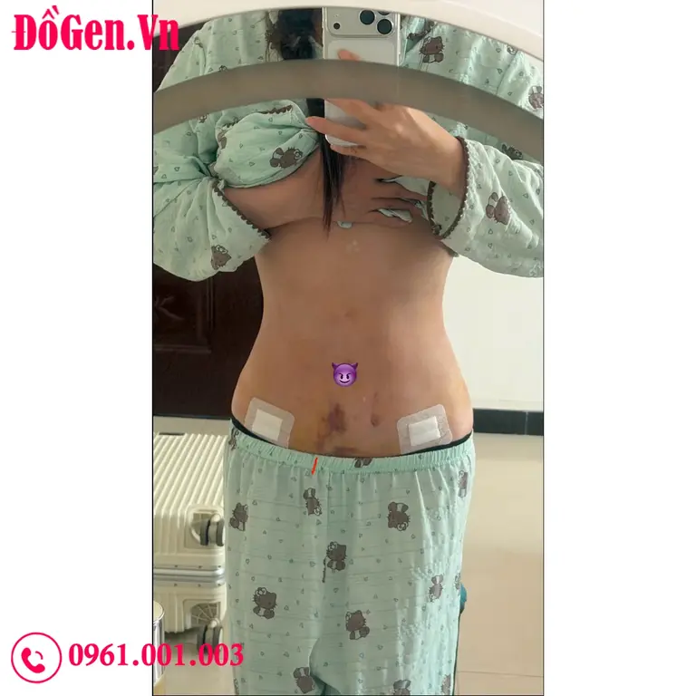 Đồ nịt toàn thân giúp giảm sưng sau hút mỡ hiệu quả