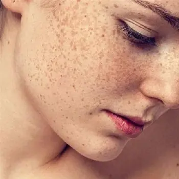 Trị nám tàn nhang đơn giản tại nhà nhưng hiệu quả cao.