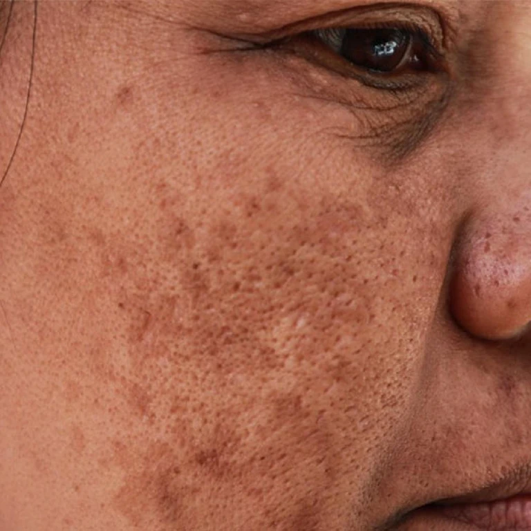 các loại nám da phổ biến