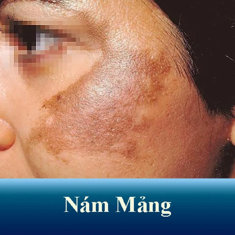 các loại nám mảng