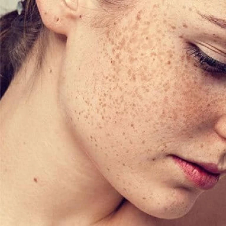 các loại nám điểm